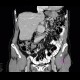 Hypervascular tumour of pancreatic head: CT - Computed tomography